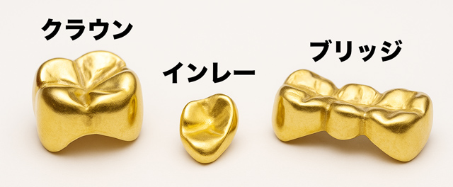 売れる金歯の種類